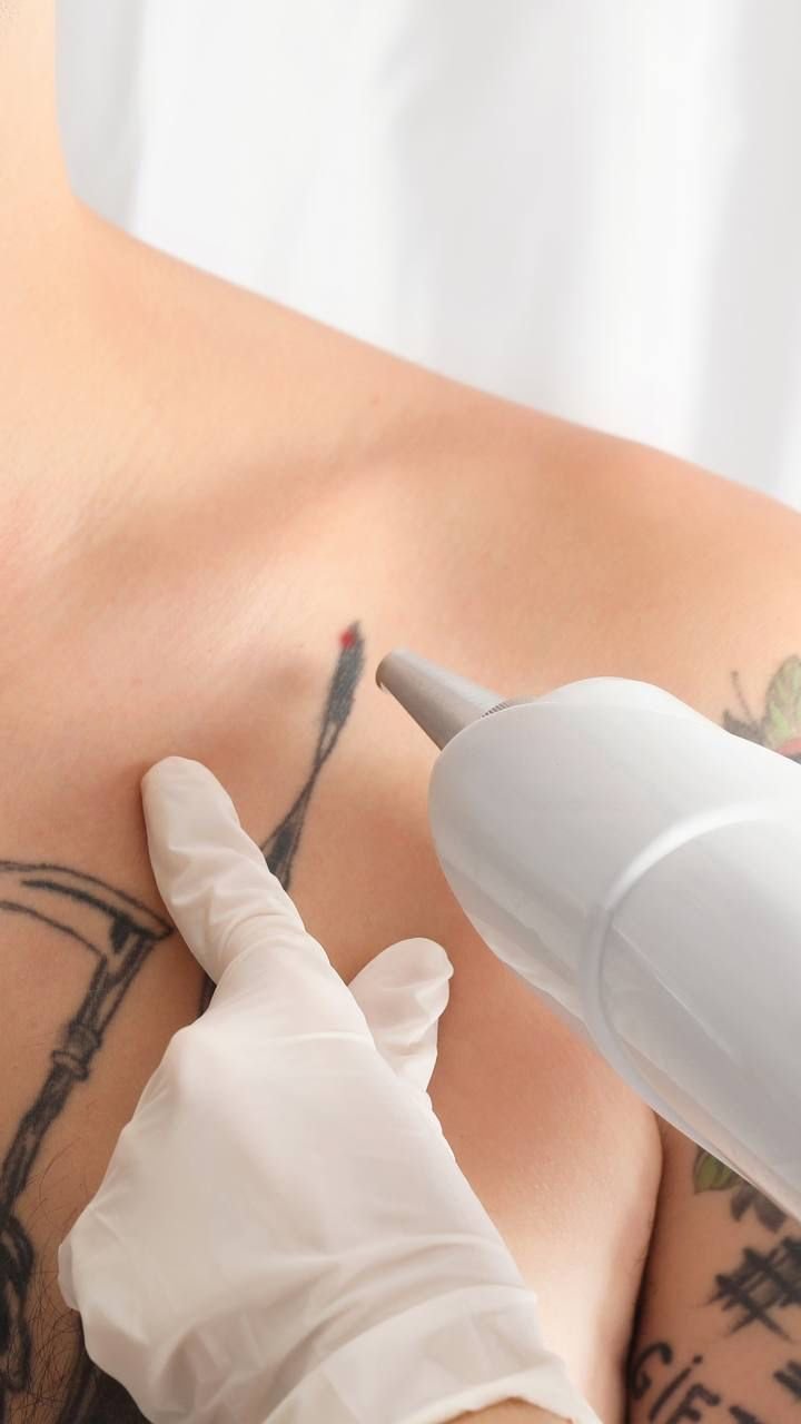 How Many Sessions Does Laser Tattoo Removal Really Take?